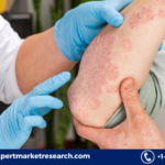 Plaque Psoriasis Treatment